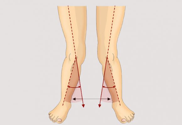 درمان زانو و پای ضربدری بدون عمل جراحی(حرکات اصلاحی و ورزش)